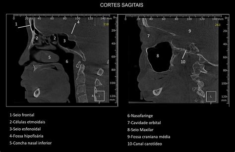 Anatomia Radiográfica dos seios paranasais Parte 1 XXXV Papaiz