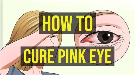 How To Cure Pink Eye Fast 5 Quick Ways Youtube