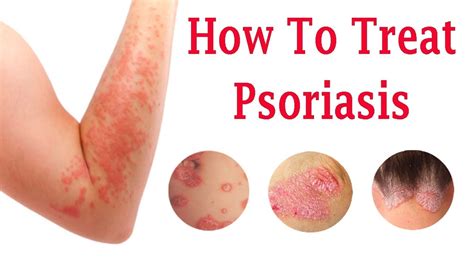 Do You Know About The Causes Of Psoriasis And How To Treat Psoriasis