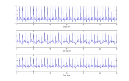 A Pure ECG Signal B ECG With BW Noise C Filtered Output By RLS