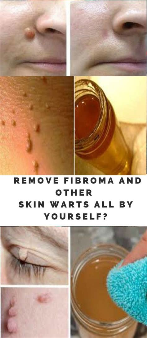 How To Remove Fibroma And Other Skin Warts All By Yourself Skin