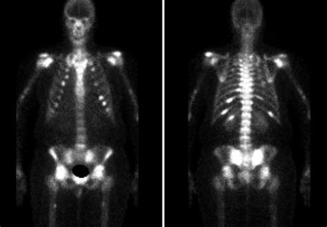 Oncogenic Osteomalacia Pearls From An Elusive Tumor A Case From The