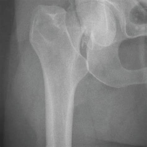 Ap Radiograph Of The Right Hip Demonstrating A Subcapital Femoral Neck