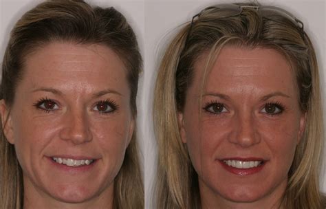 Before And After Porcelain Veneers South Shore Dental Care Blog
