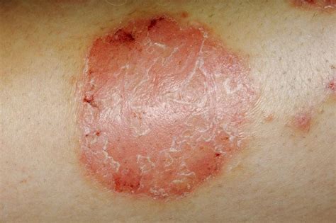 Psoriasis In Children Causes And Treatment Huffpost Uk Parents