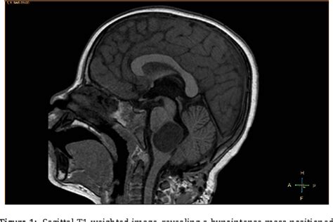 Figure 1 From A Unique Case Of Medulla Oblongata Epidermoid Cyst