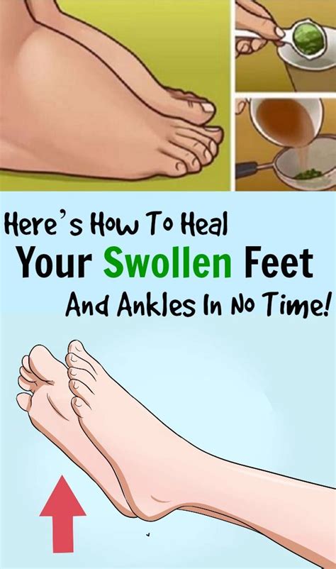 Heres How To Heal Your Swollen Feet And Ankles In No Time Foot