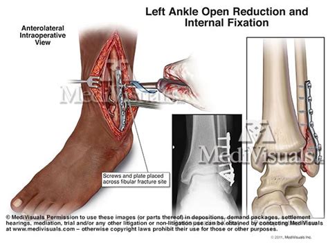 Left Ankle Open Reduction And Internal Fixation Custom Illustration