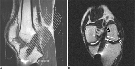 Oblique Coronal Mr Images Of Anterior Cruciate Ligament Open I