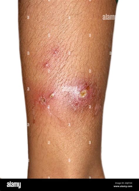 Leg Ulcer Cellulitis Hi Res Stock Photography And Images Alamy
