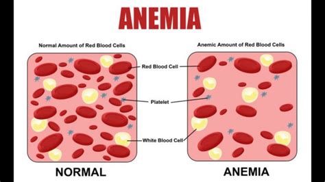 Anemia Symptoms Causes And Its Treatment Explained Video