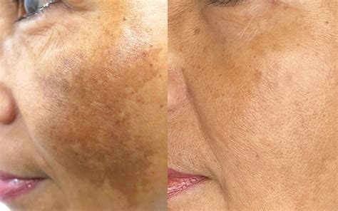 Best Melasma Treatments In Brisbane Cutis Dermatology