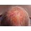 VIRTUAL GRAND ROUNDS IN DERMATOLOGY 20 78 Yo Man With Scalp Lesions