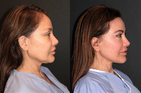 Deep Plane Facelift Before And After Dr Andrew Jacono Facelift
