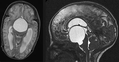 A Suprasellar Arachnoid Cyst Resulting From An Intraventricular
