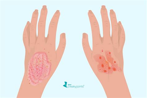Common Skin Conditions Eczema Dermatitis Psoriasis Guide Ph