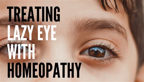 lazy eye blog dr amit homeopathy eyes homeopathic remedies