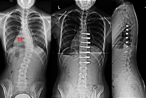 Non Fusion Corrective Scoliosis Surgery Scoliosis And Spine Associates