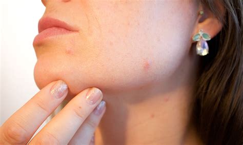 Skin Conditions Raised Bumps That Look Like Pimples But Actually Aren