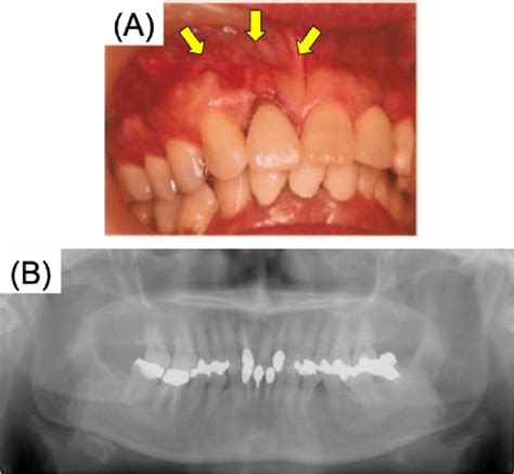 First Examination Showing Swelling Arrow Diagnosed As Gingival Scc Of