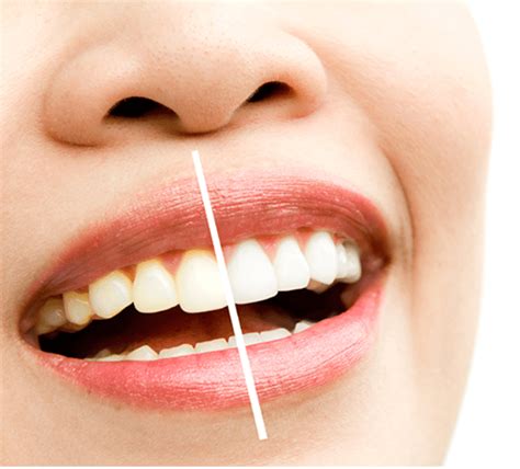 Aligning Beauty Best Smile Makeover Dental Clinic In Kilpauk Chennai