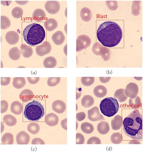 Lymphoma A Blast B Lymphocyte C And Other Cell D Download