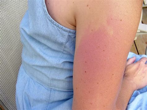 Getting A Covid Arm Rash After The Moderna Vaccine Might Be Itchy