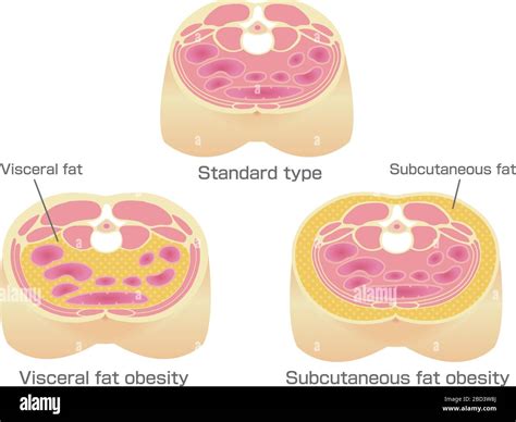 Type Of Obesity Illustration Abdominal Sectional View Visceral Fat