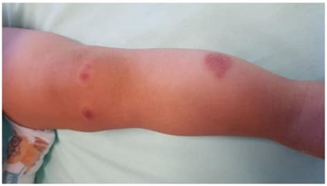 Ijerph Free Full Text Targetoid Skin Lesions In A Child Acute