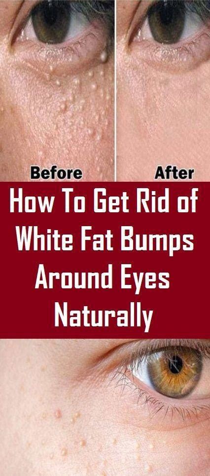 How To Get Rid Of White Fat Bumps Around Eyes Naturally Lillian