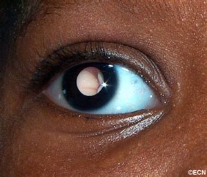 Maybe you would like to learn more about one of these? Case #13: Retinoblastoma » New York Eye Cancer Center