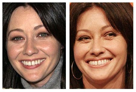 Plastic Surgery Before After Shannen Doherty Plastic Surgery