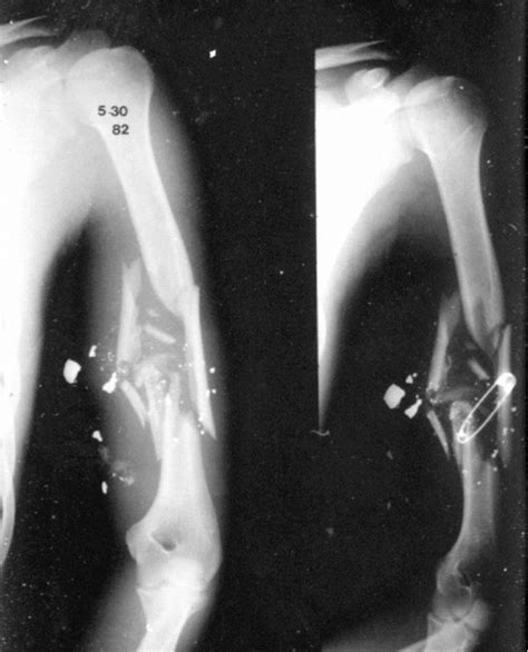 The Evolution Of Functional Bracing Of Fractures Bone And Joint