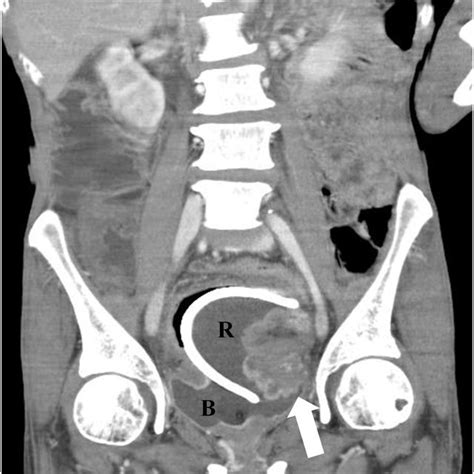 A Extensive Vaginal Lacerations At 5 And 8 Oclock Position In Female