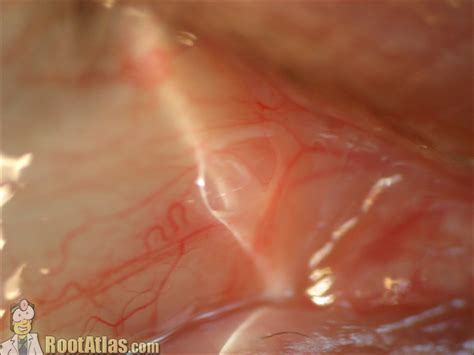 Conjunctival Fluid Filled Cyst