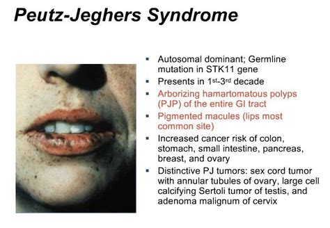 Peutz Jegher Syndrome Lentigines Ie Mucocutaneous Hyperpigmentation
