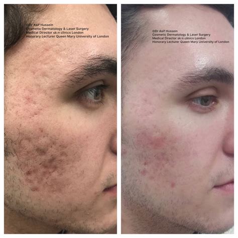 Laser For Acne Scars Cosmetic Surgery Tips