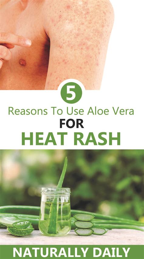 How To Use Aloe Vera Plant For Skin Rash Plantă Blog