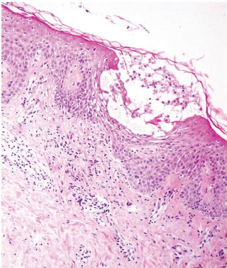 The Histopathology Revealed Epidermal Spongiosis And Dermal