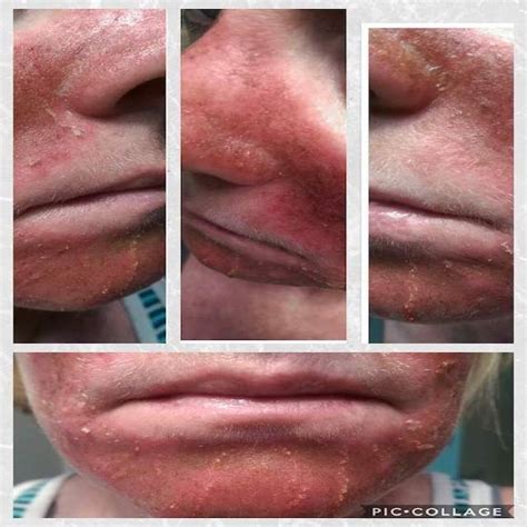 Chemo For Skin Cancer On Face Cancerwalls Hot Sex Picture
