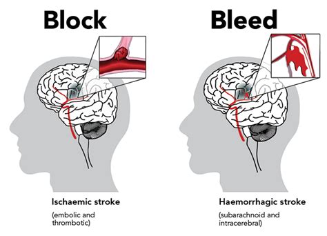 Types Of Stroke Enableme Stroke Recovery And Support