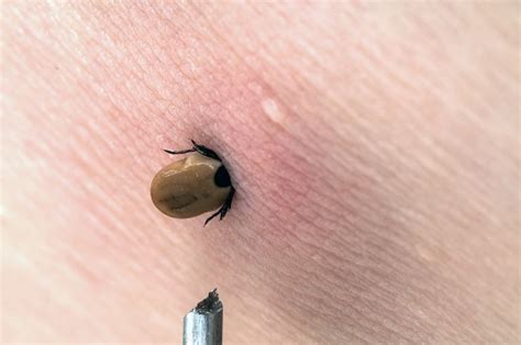 Stay Safe How To Remove A Tick Correctly