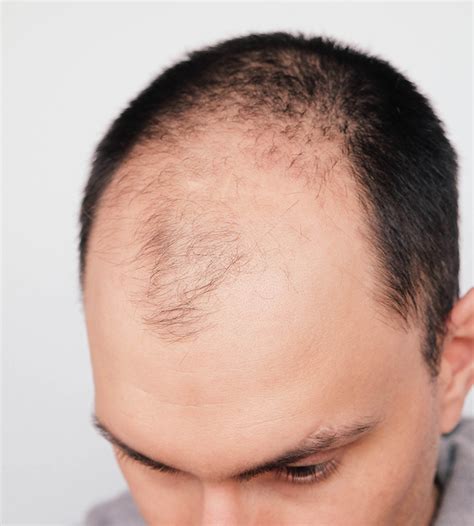 Lichen Planopilaris Hair Loss Treatment Anne Arundel Dermatology