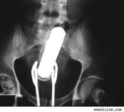 Did You Know Most Craziest Foreign Objects Found Stuck In A Rectum