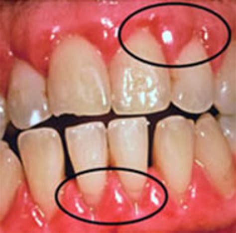 Causes Of Gum Blisters And Home Remedies For Treatment Hubpages