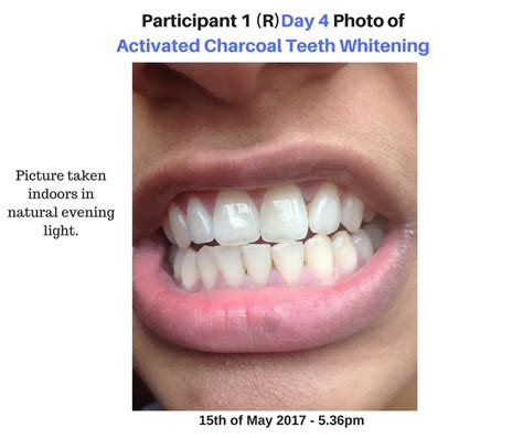 Activated Charcoal Teeth Whitening Experiment 2 Real Beforeafter Pics