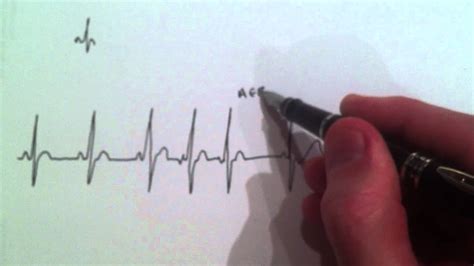 A Cardiologist Explains Atrial Ectopic Beats With An Ecg Annotation