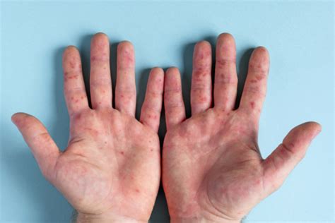 Hand Fuß Mund Krankheit Symptome Und Behandlung