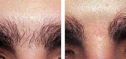 Laser Hair Removal Laser Advantage