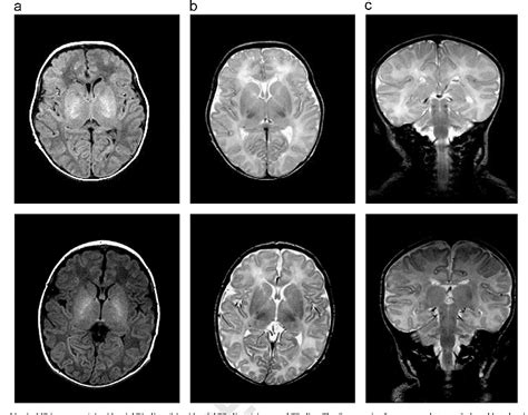 Neonatal Brain Mri Segmentation A Review Semantic Scholar